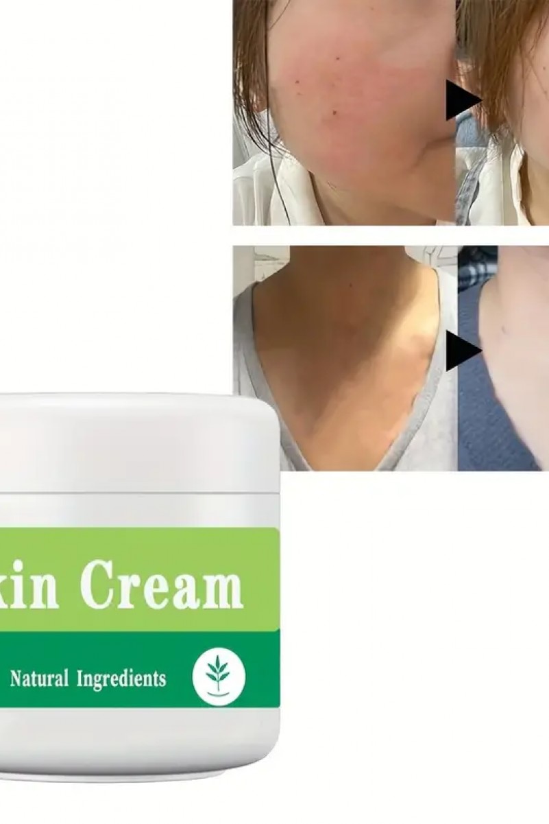 Psoriasis-Cream