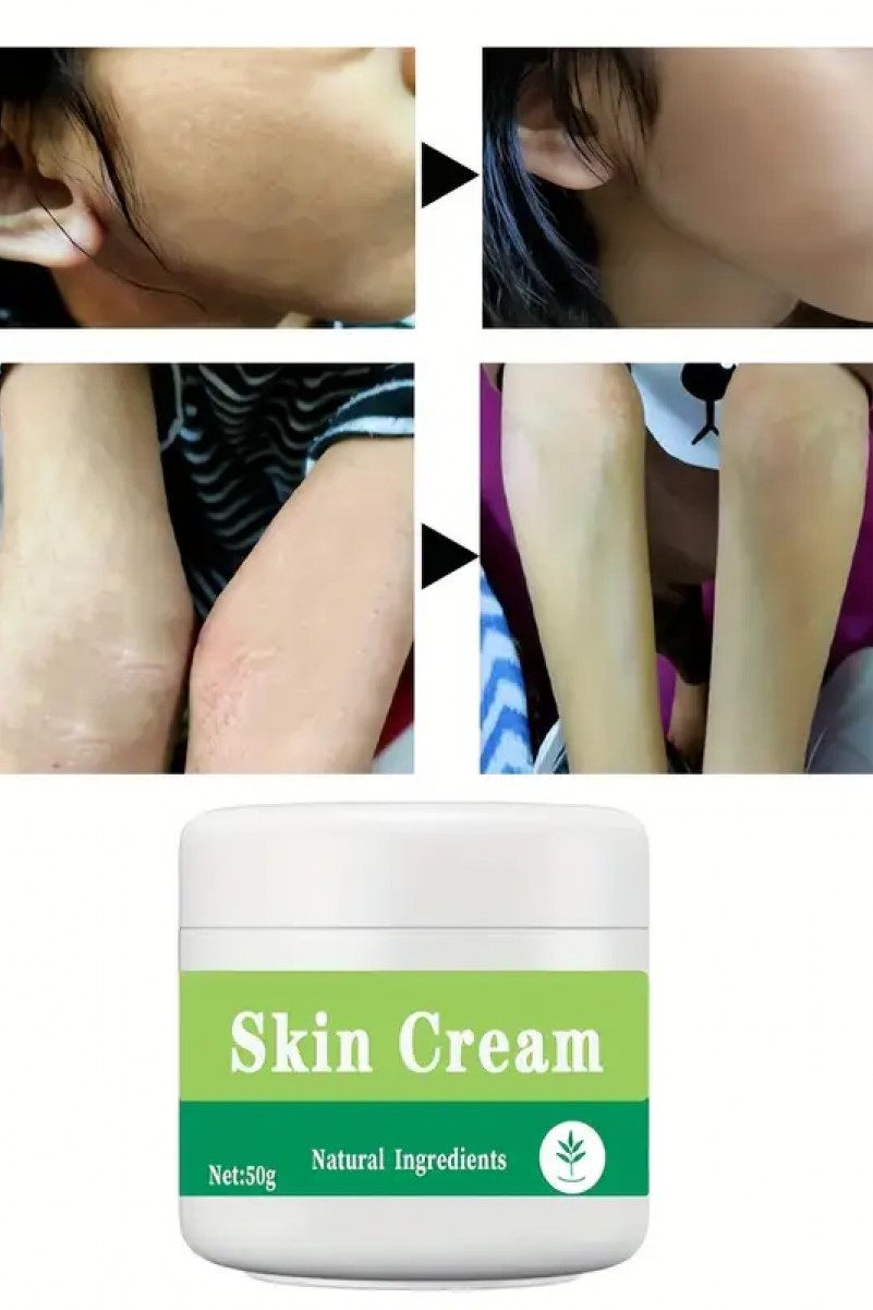 Psoriasis-Cream